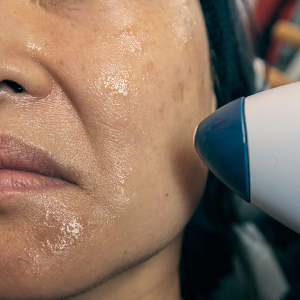 What Is Radio Frequency Skin Tightening?